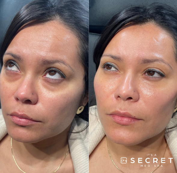 Undereye Injection Treatments It's A Secret Med Spa