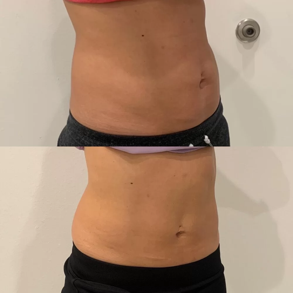 Before and after of CoolSculpting to a woman's abdomen.