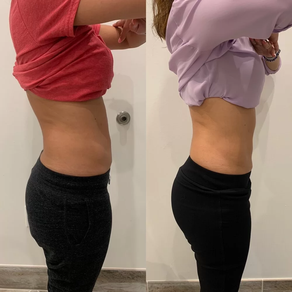Before and after of CoolSculpting to a womans abdomen.