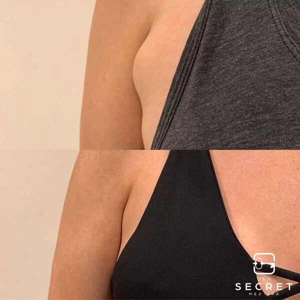 Before and after of CoolSculpting to a woman's armpit area.