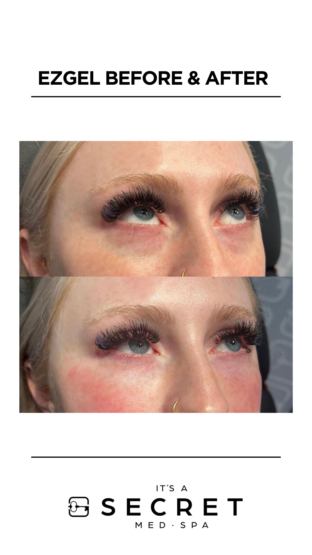EZ Gel (3) Amazing results of skin rejuvenation with ez gel plasma filler at It's a Secret Med Spa