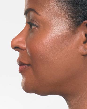 Kybella Treatment After Photo