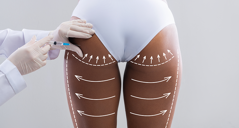 Experience an immediate, subtle enhancement with our non-surgical butt lift, designed to augment your volume and smooth hip dips.