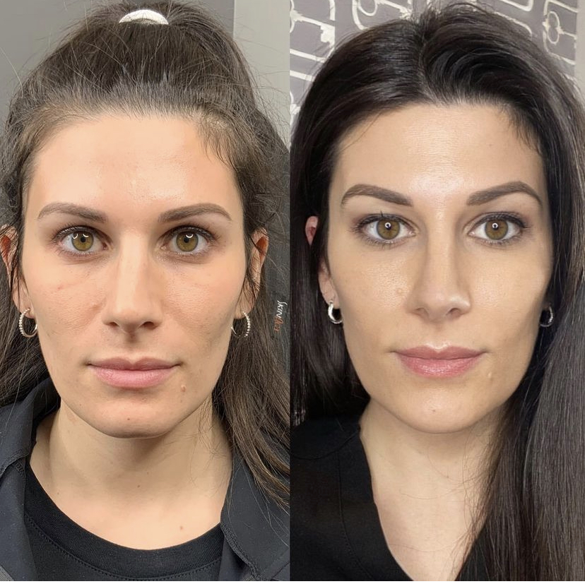 Remarkable before and after results of Sculptra treatment at It's A Secret Med Spa, showcasing enhanced volume and texture