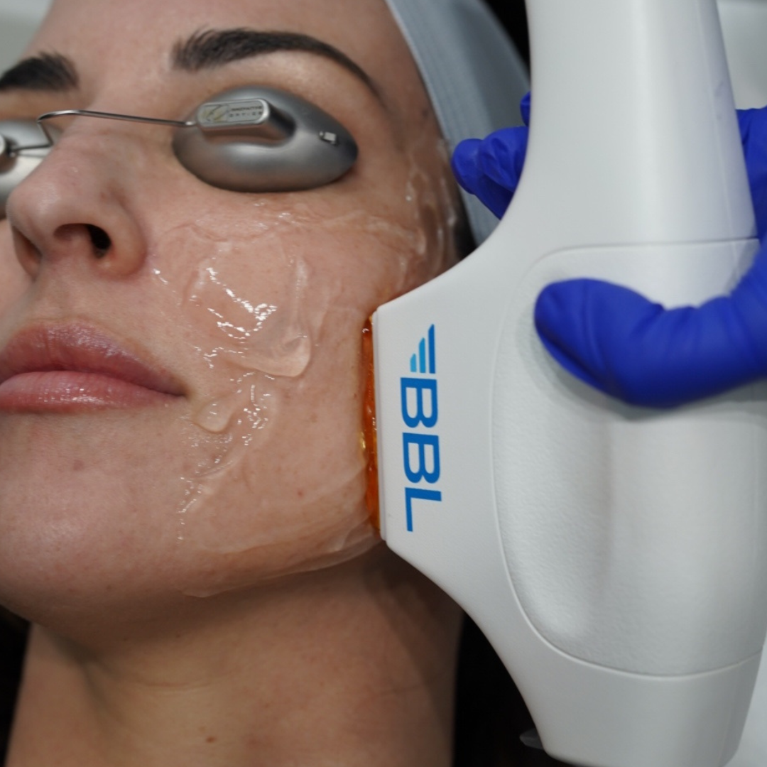 What Its Like BBL Photofacial Laser Treatment in Plano, TX