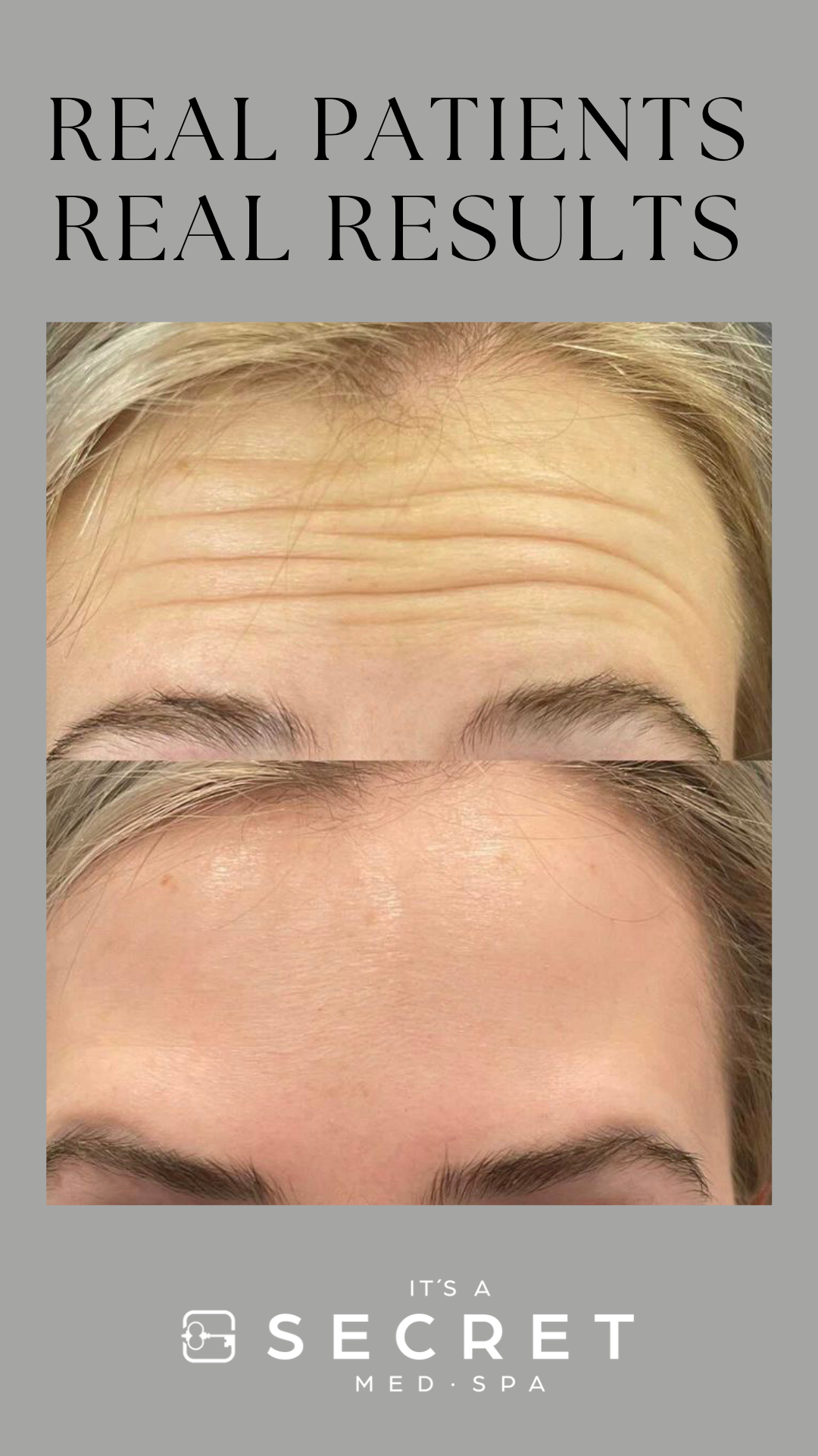 woman showcasing the effects of Xeomin where her severe frown lines have vanished