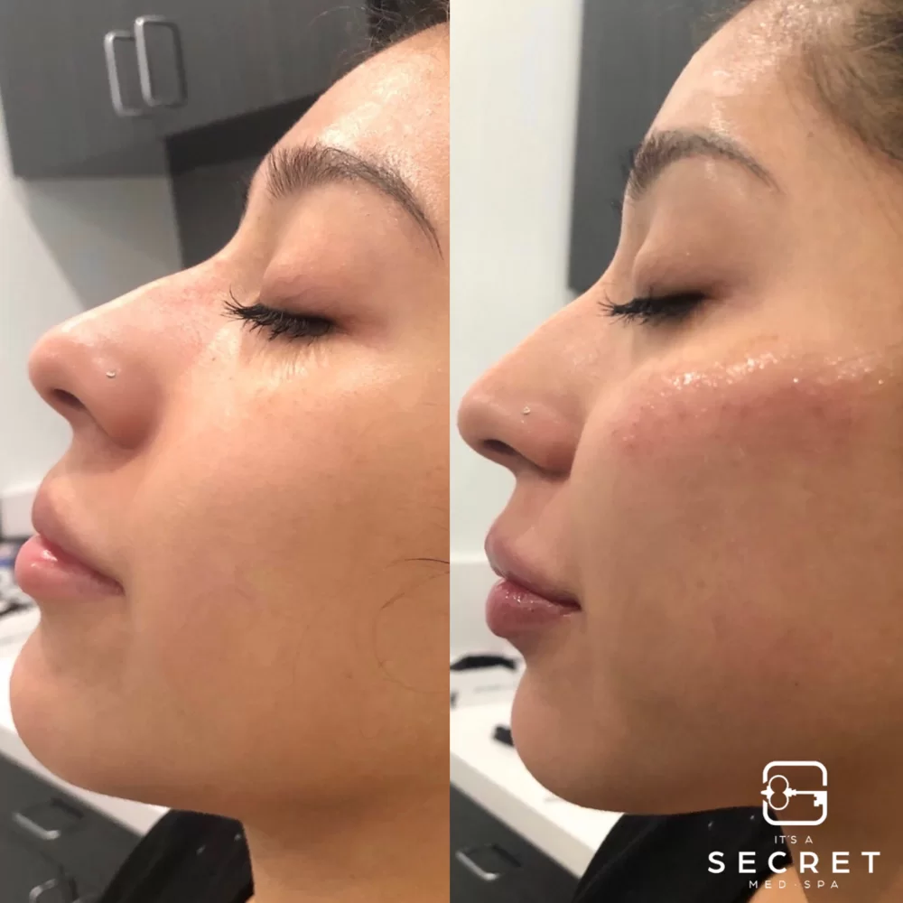 Cheek filler before and after at It's a Secret Med Spa