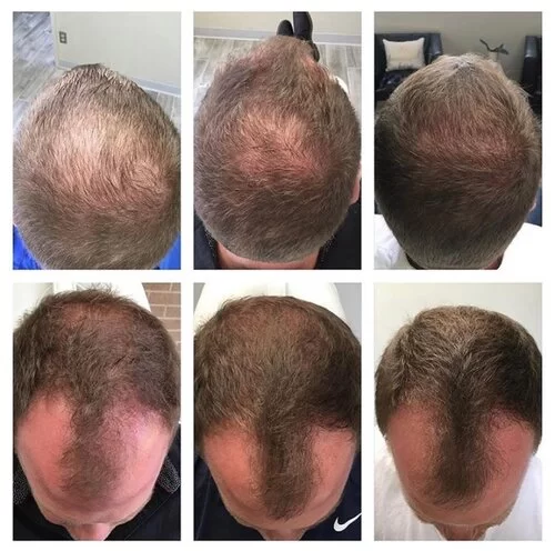 PRF Hair Loss Treatment | Hair Restoration & Growth - It's A Secret Med Spa