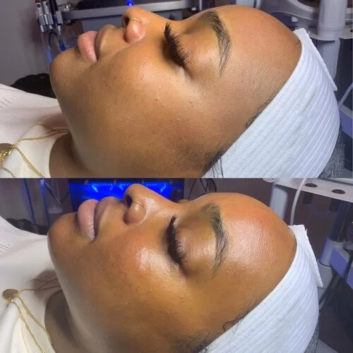 Hydrafacial before and after