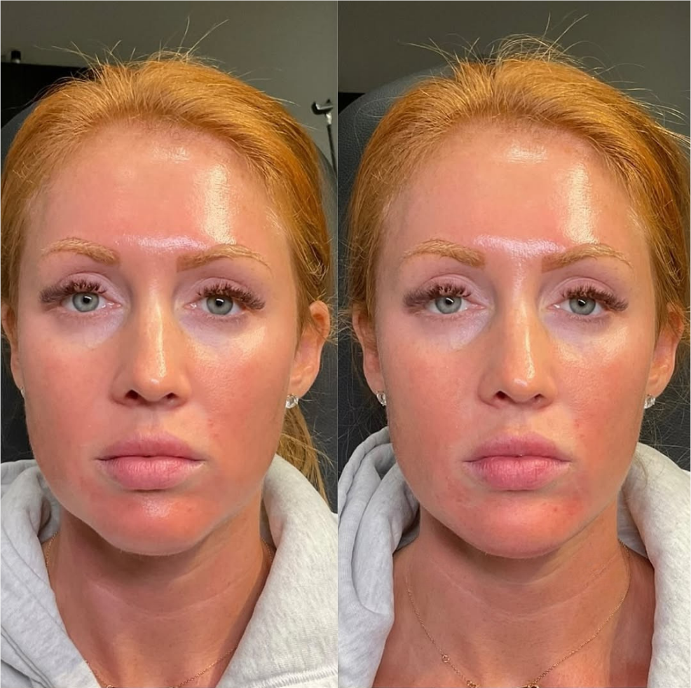 facial balancing - before and after