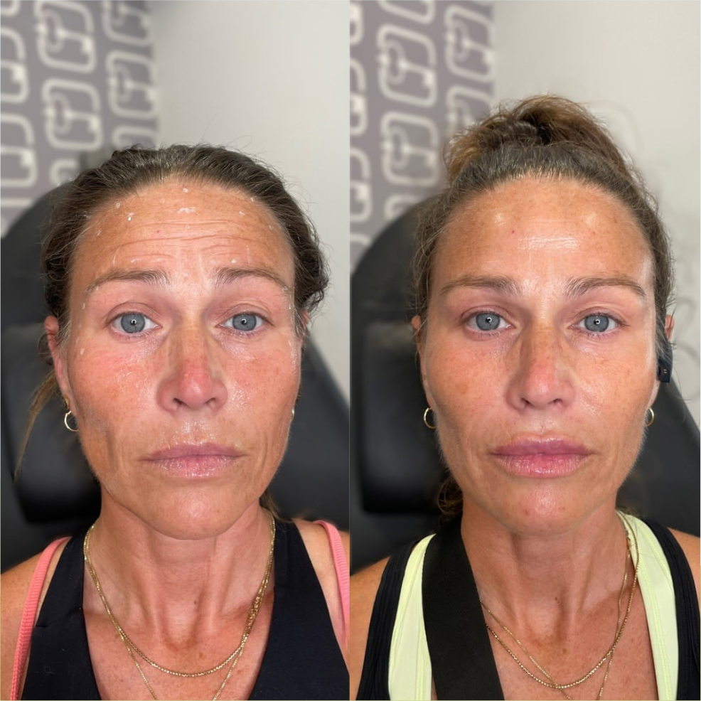 facial balancing - before and after