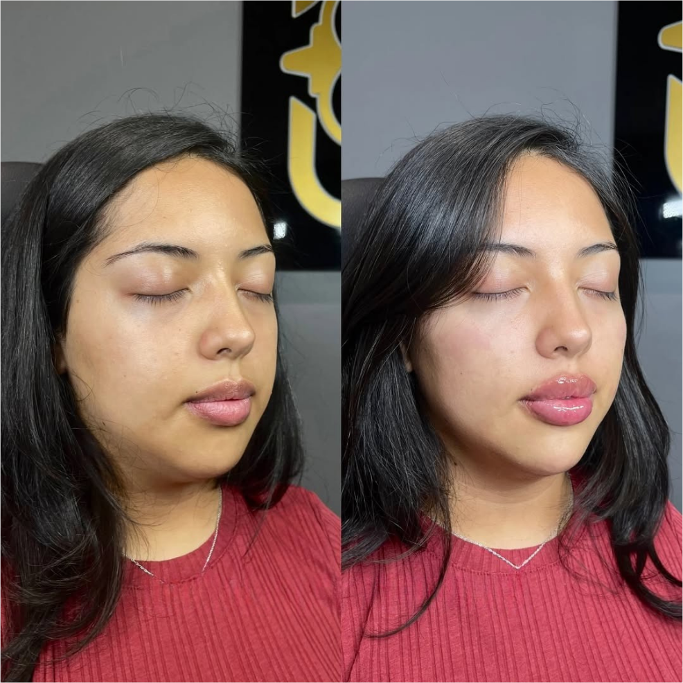 facial balancing - before and after