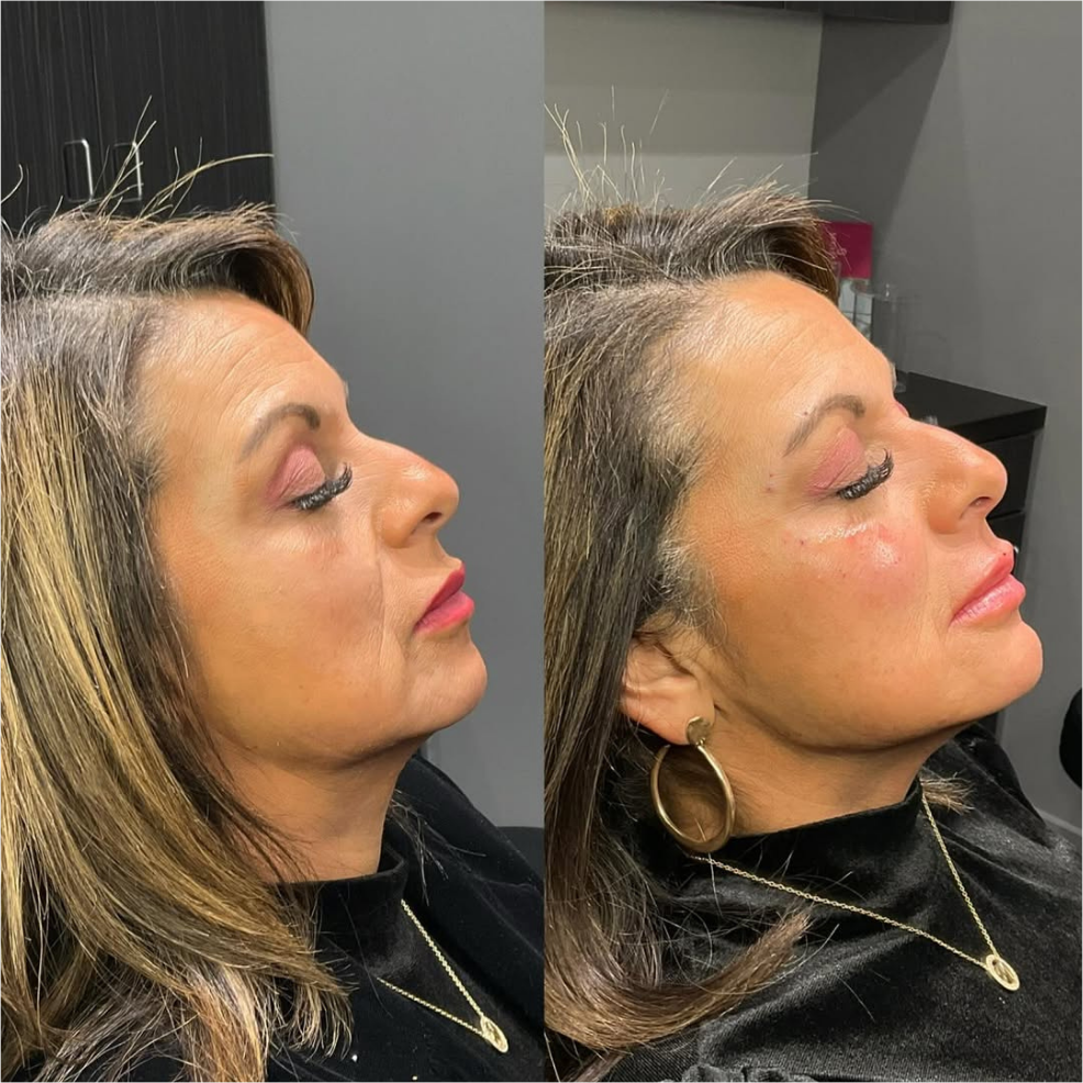 facial balancing - before and after