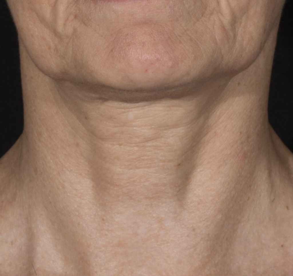 Picture of older womans neck before Potenza treatment, showing somewhat sagging skin