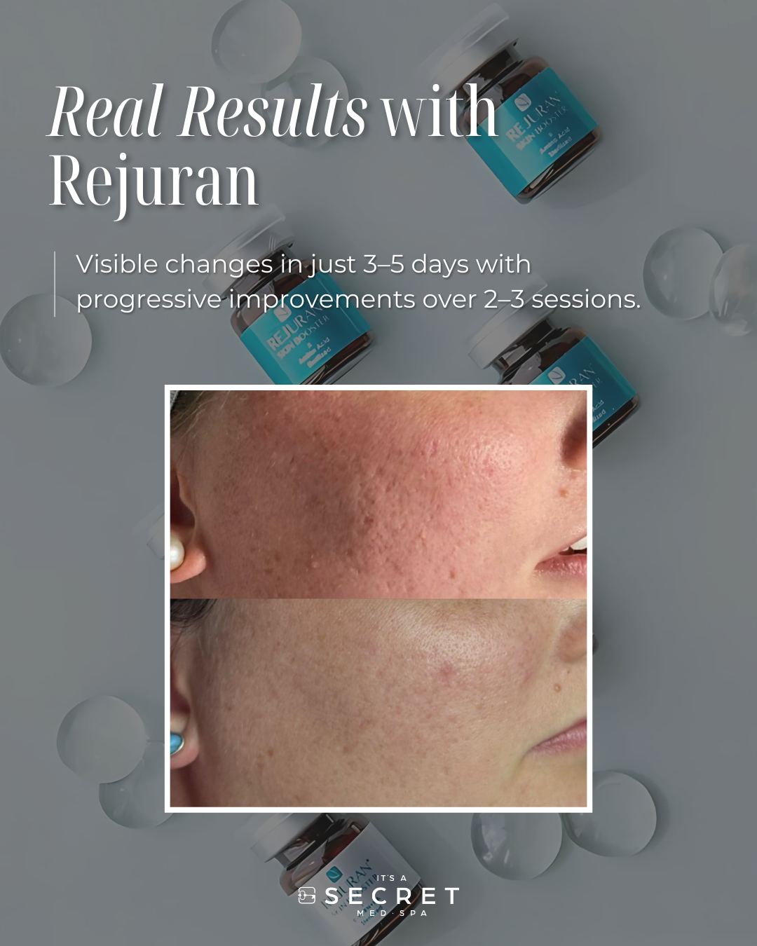 rejuran 82 Real Results with Rejuran - Part of It's A Secret's K Beauty Collection